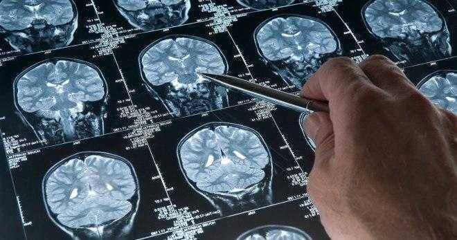 Обзор МРТ мозга на медицинском изображении с ручкой