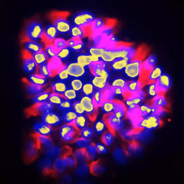 Искусственный интеллект MangroveGS предсказывает метастазы рака с точностью 80%